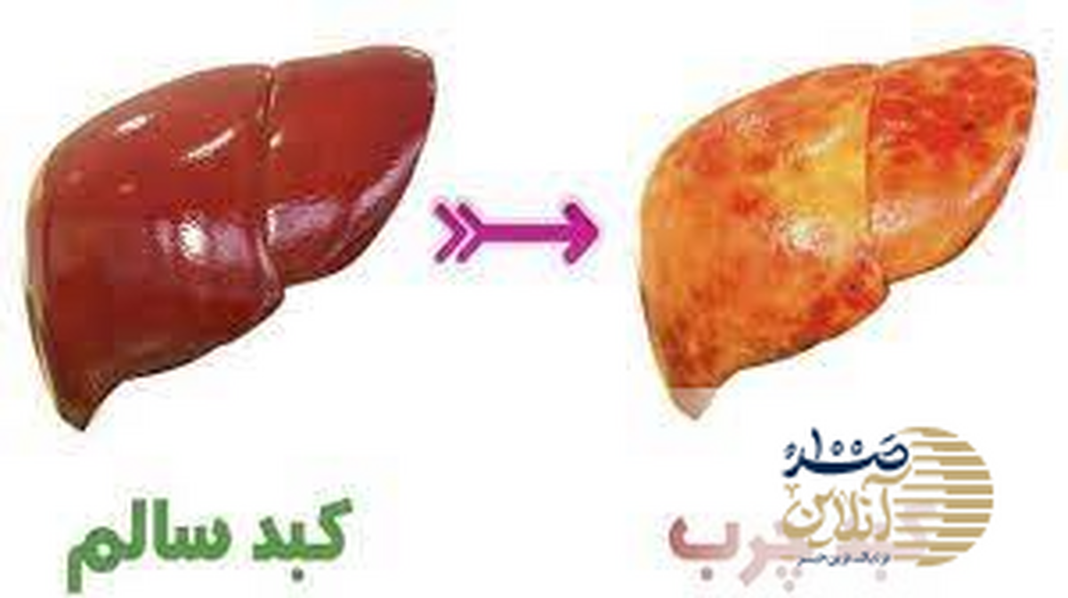 درمان کبد چرب با رژیم ژاپنی؟ معجزه بیماری کبد چرب