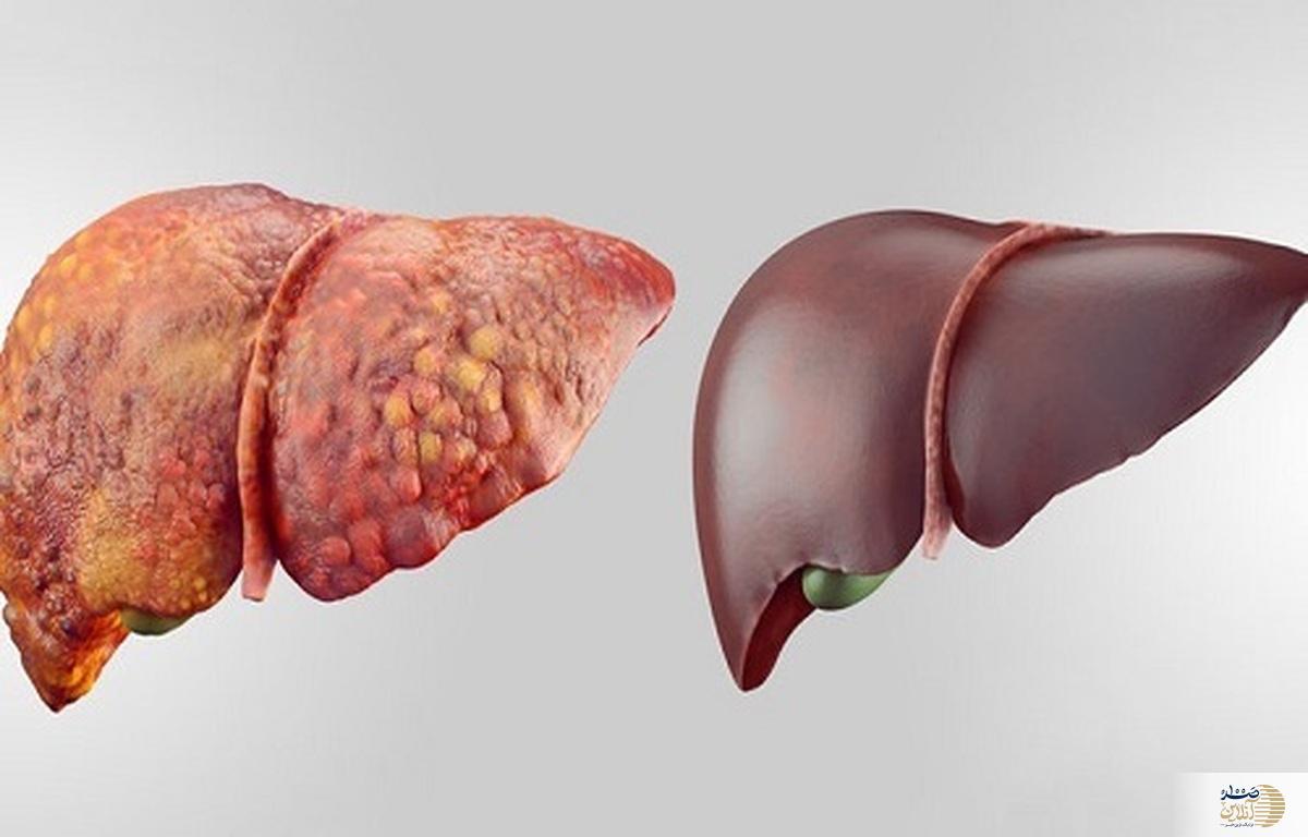 این علائم یعنی متاسفانه مشکلات کبدی دارید