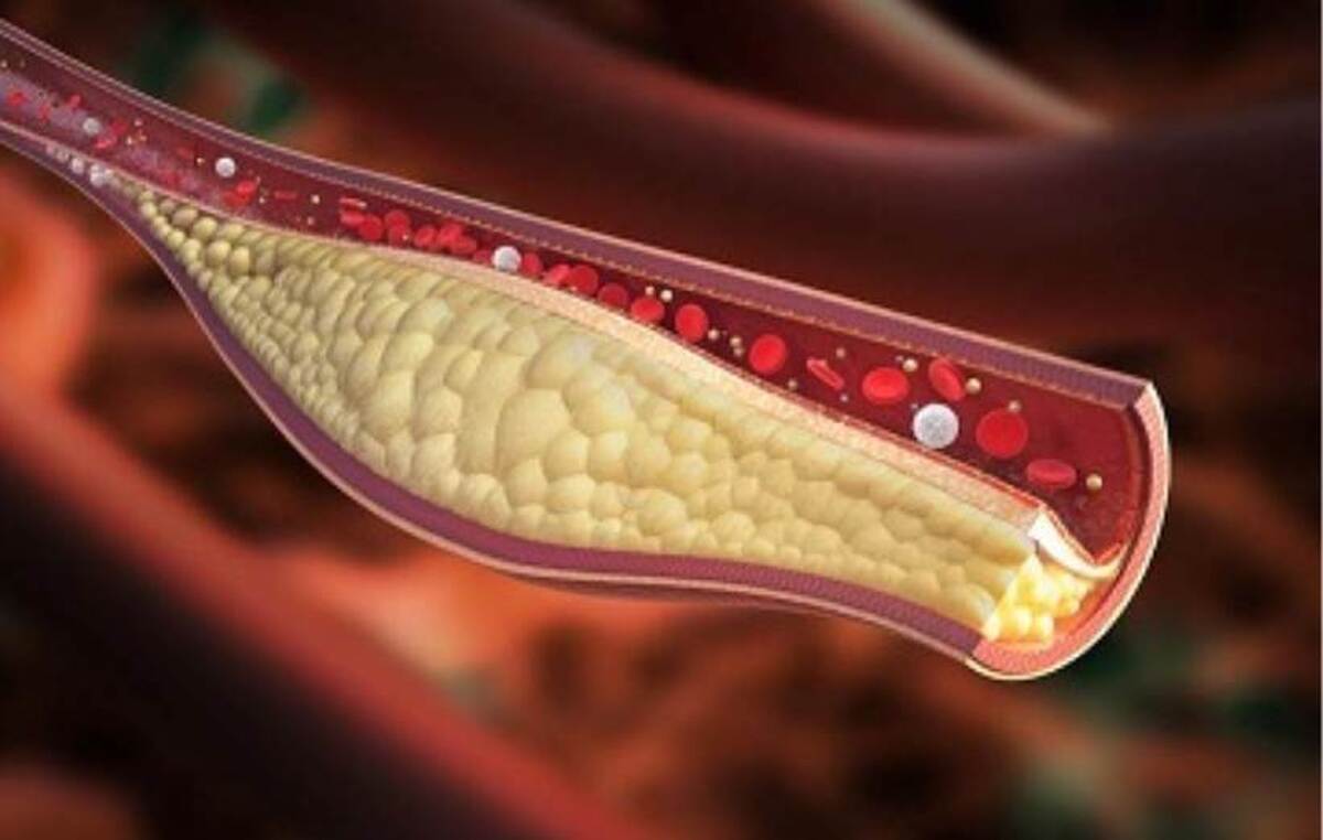 ۴ راهکار مفید و غیردارویی برای کاهش سریع کلسترول بد خون