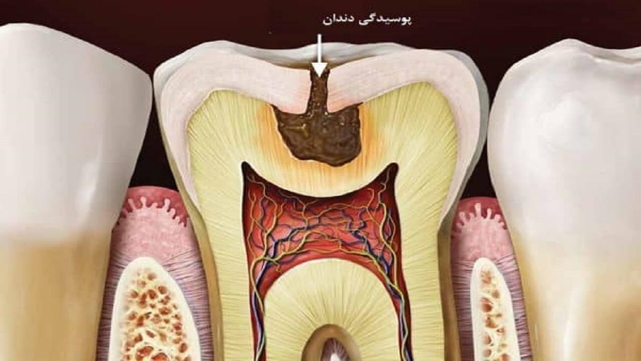 مشکلات جدی سلامتی که پوسیدگی دندان برای بدن به بار می‌آورد