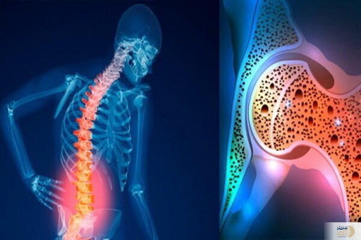 چرا این زنان بیشتر به پوکی استخوان مبتلا می‌شوند؟