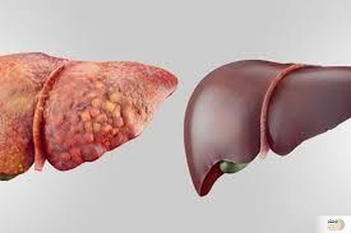کبد چرب را با این رژیم غذایی شکست دهید
