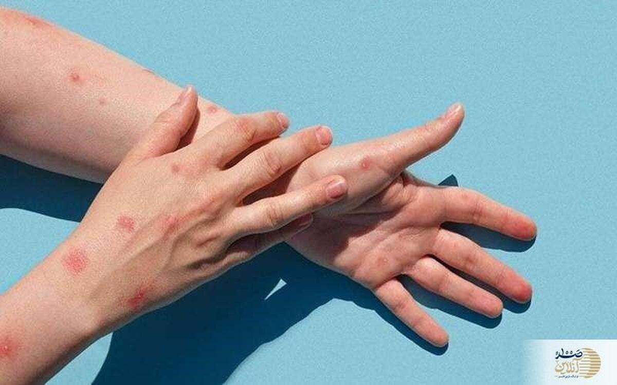 هشدار بهار  موج آبله مرغان در راه است!