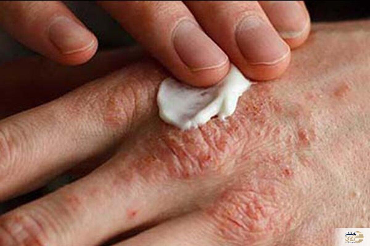 شما هم از اگزمای بهاری خسته شده اید؟