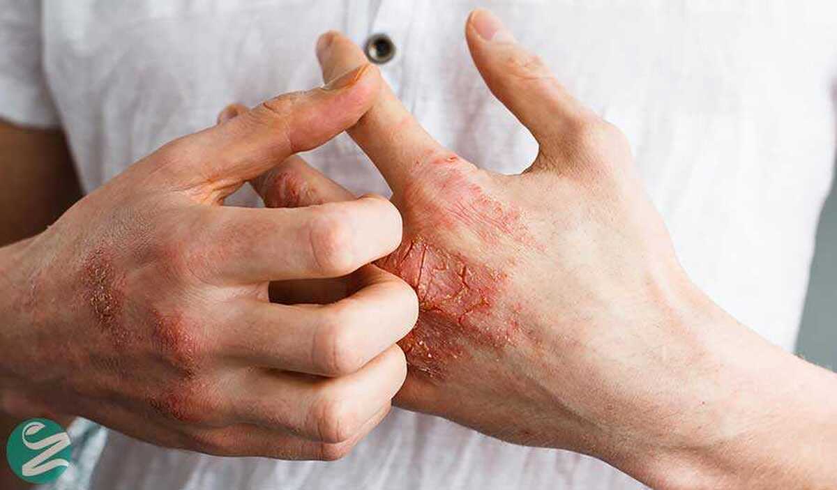 بشنوید| بیماری اگزما (درماتیت) و پیشگیری، علل، علائم و درمان