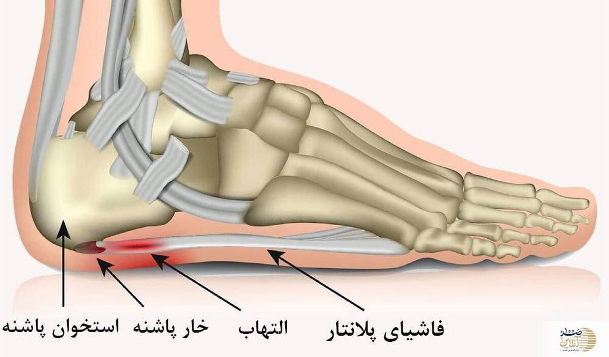چگونه خار پاشنه پا را درمان کنیم؟  روش‌های موثر!