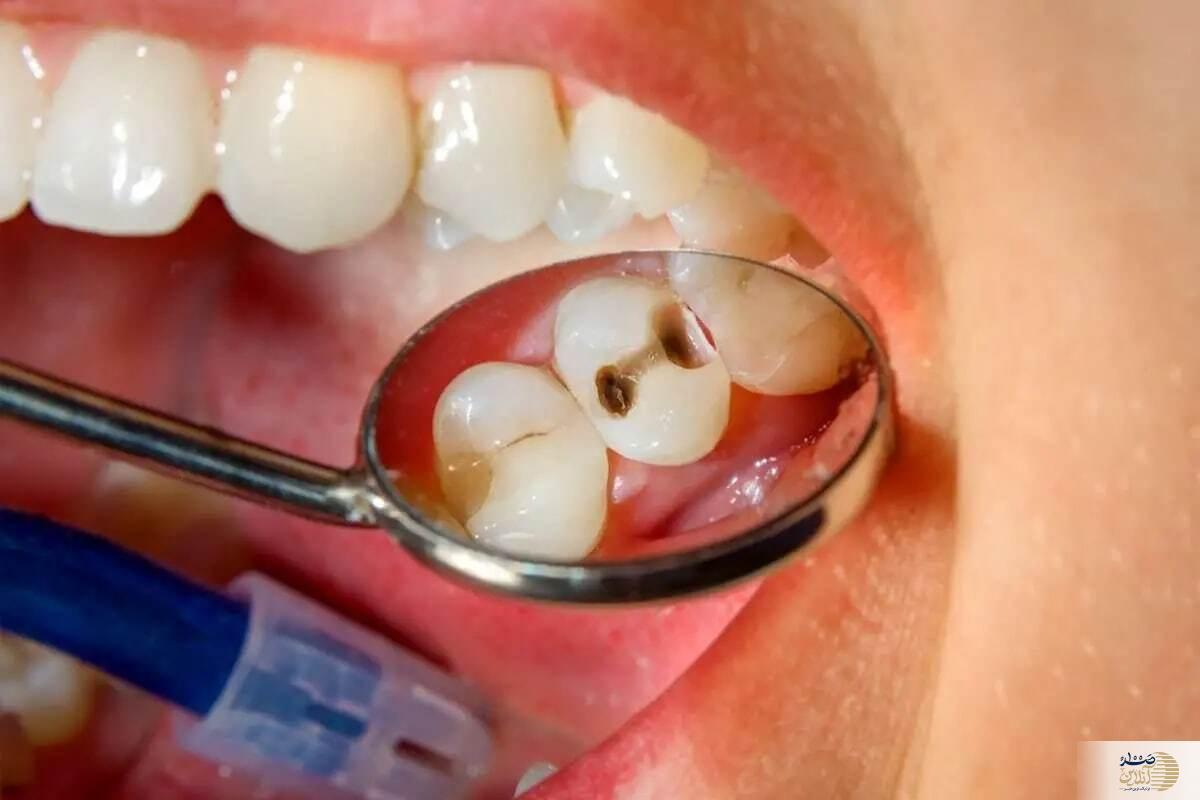 این اشتباهات باعث پوسیدگی دندان می‌شود/ حتما جدید بگیرید