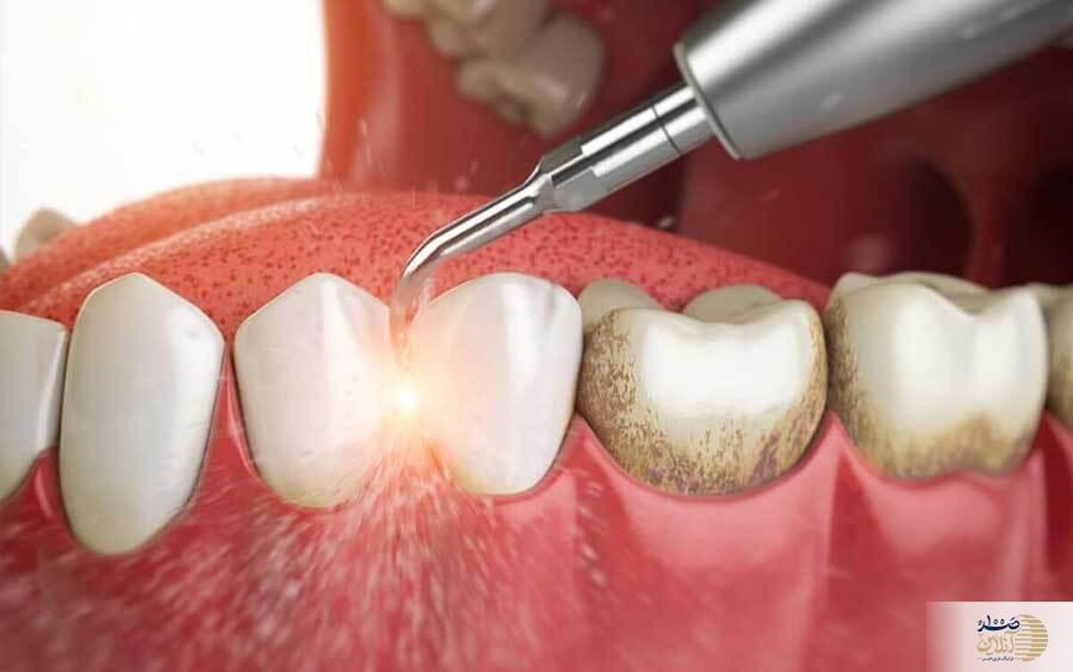 بشنوید|  جرم دندان: چرا اینقدر مهمه و چطور میتونید از شرش خلاص بشید؟