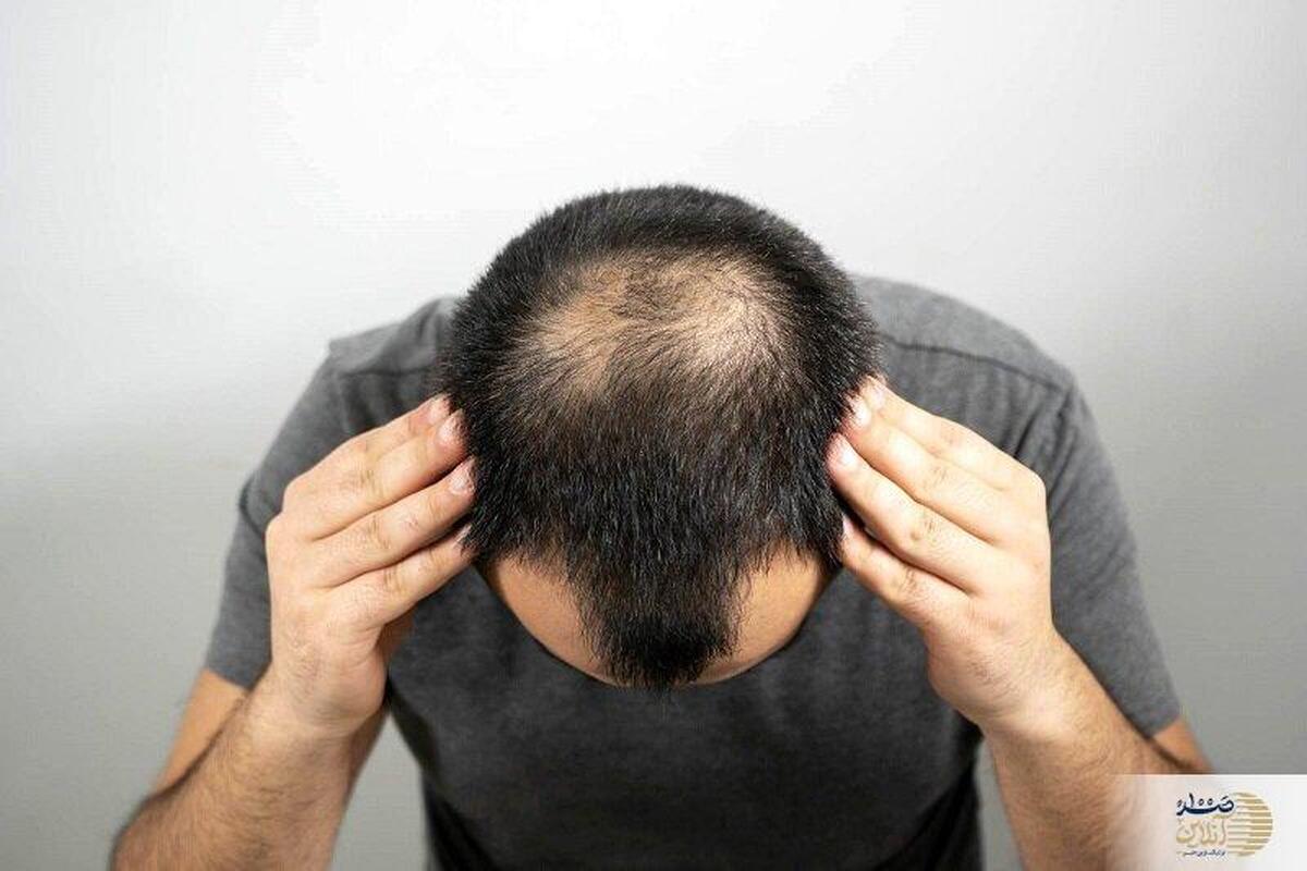 درمان‌های طبیعی ریزش مو/ حقایقی درباره ریزش مو که نمی‌دانستید