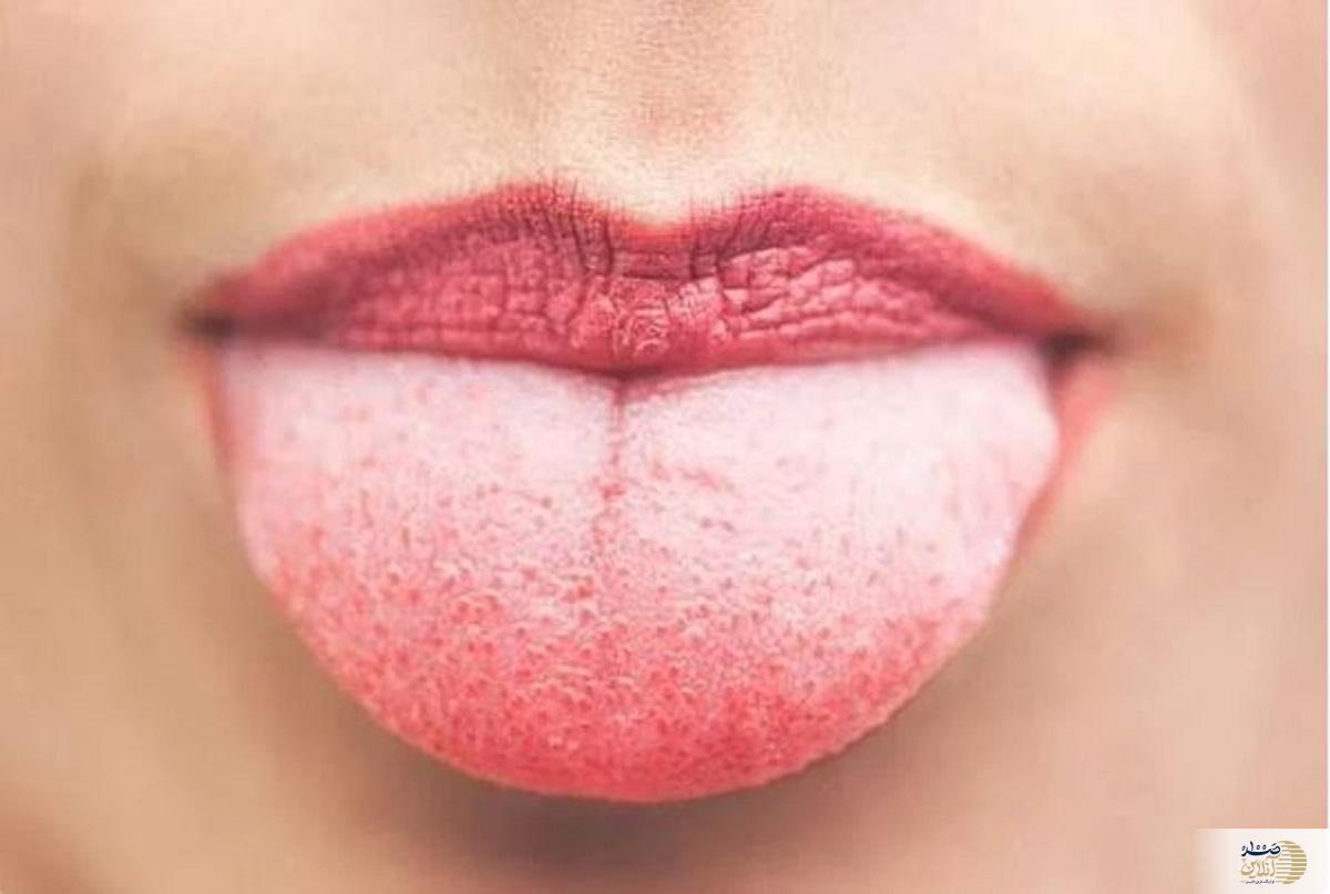 بیماری‌های عجیبی که روی زبان می‌نشینند