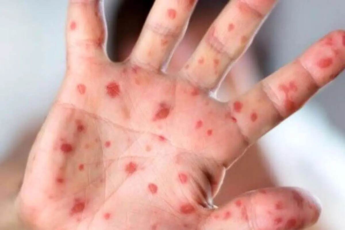 شیوع هشدار‌دهنده سرخک در این شهر ایران