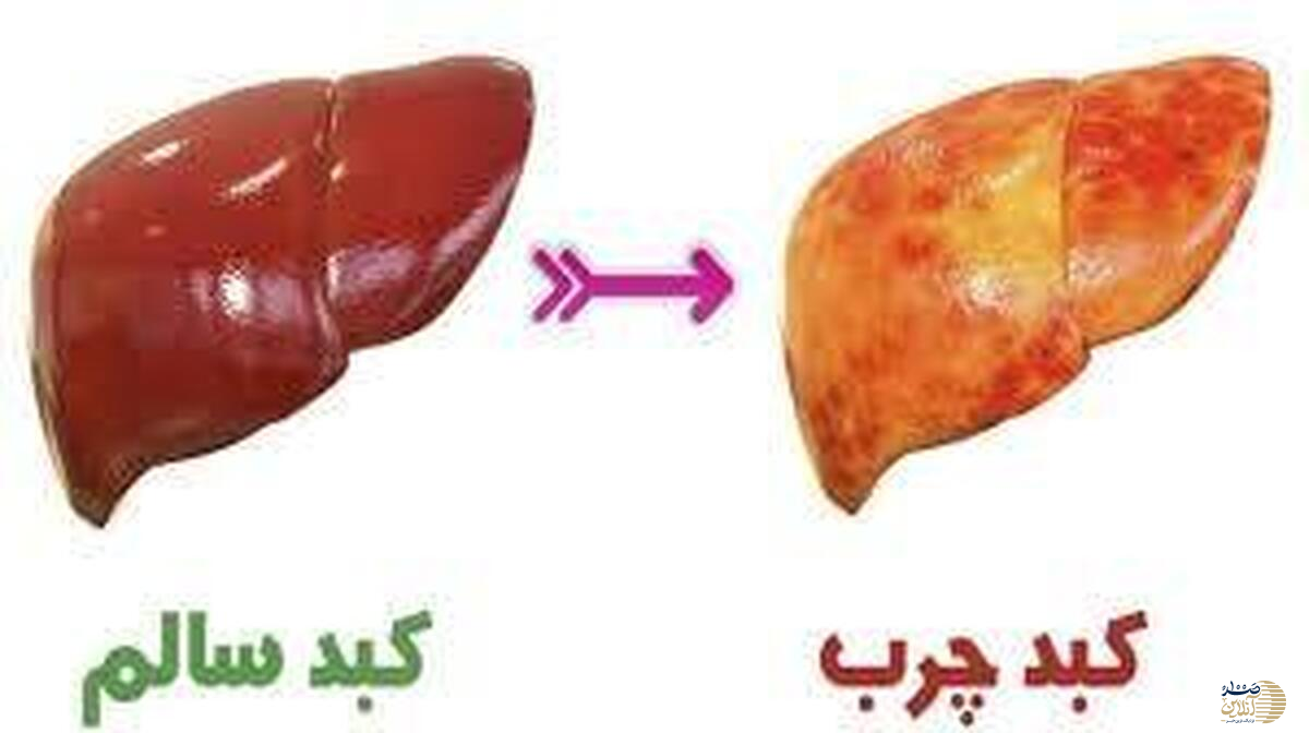 باید و نباید های صبحانه برای کبد چرب