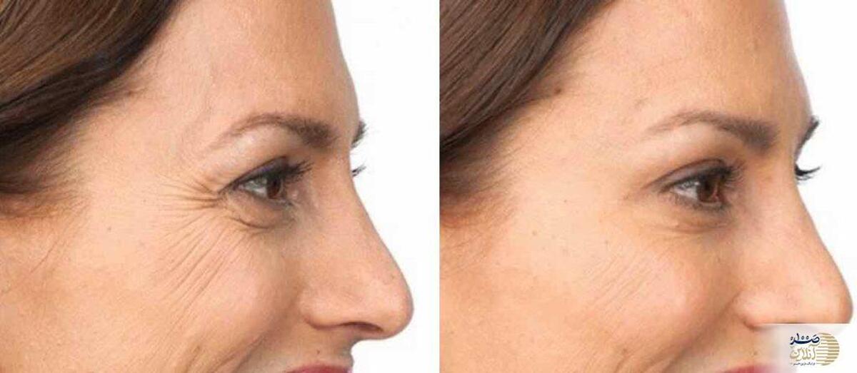 بشنوید| بوتاکس/ معجزه زیبایی یا تهدید سلامت؟/ تمام واقعیت‌ها فاش شد!
