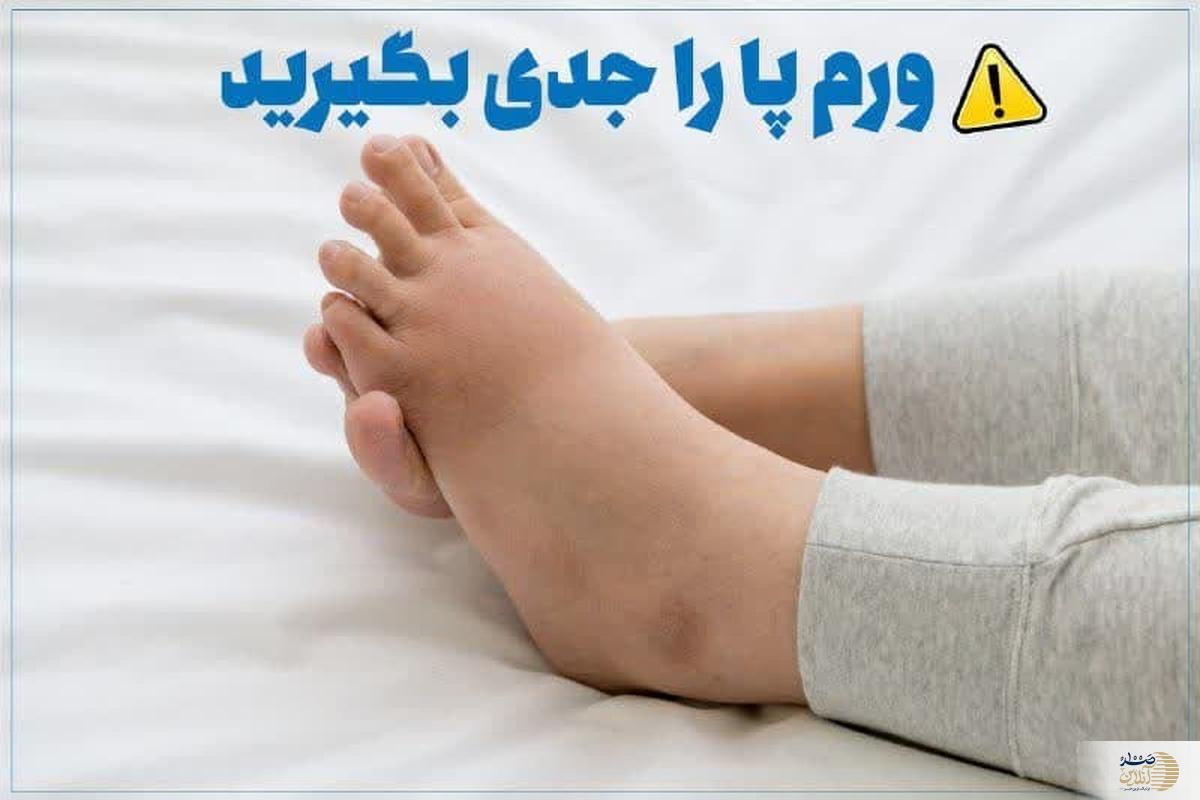 ورم پا را جدی بگیرید تا دیر نشده