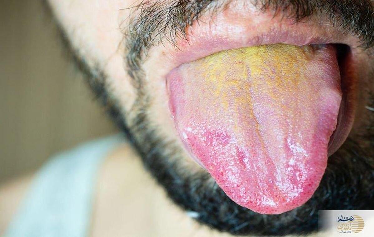 چرا زبانتان زرد می‌شود؟/ رازهایی که هیچ پزشکی نگفته است