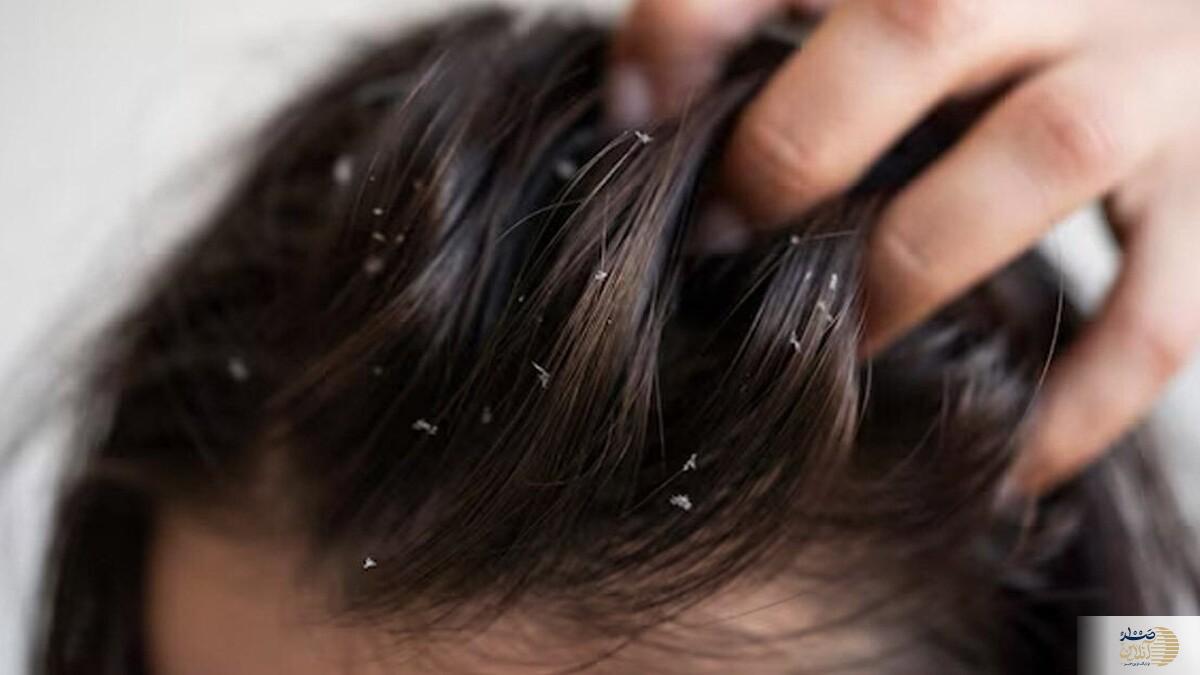 از دست موهای چرب خسته شده اید این مطلب مخصوص شماست