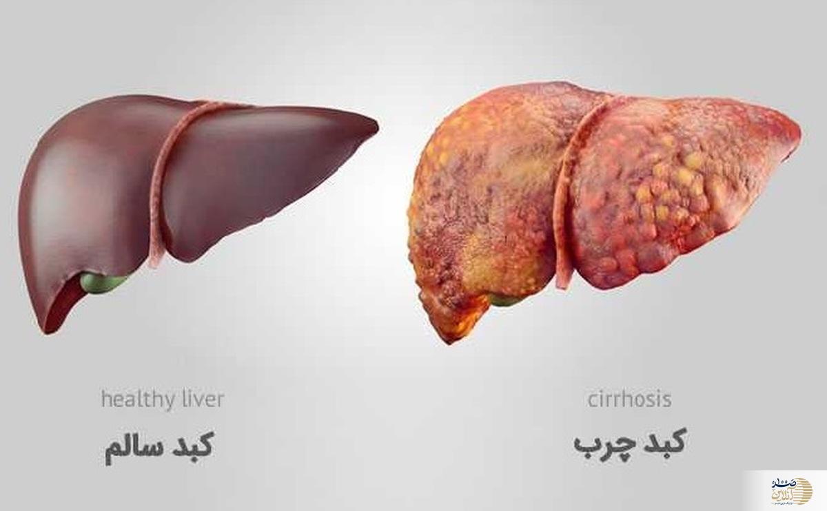 کبد چرب تان روی اعصاب است/ نکات طلایی را بخوانید