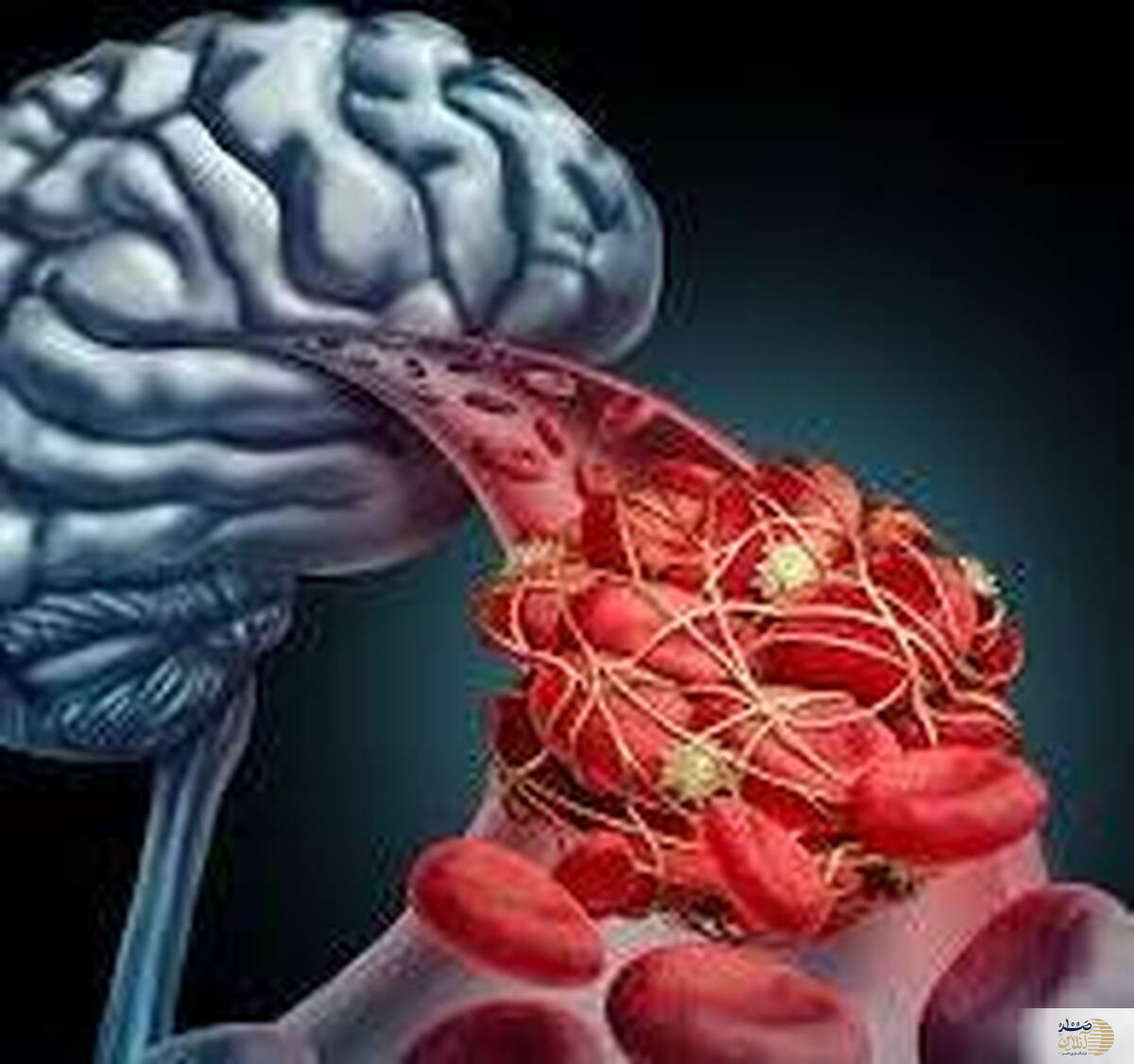 با این روش ها از سکته مغزی در صبح جلوگیری کنید
