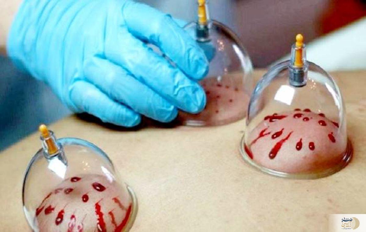 از سردرد تا فشار خون/ معجزه حجامت زیر ذره‌بین