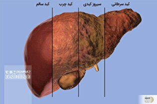 ببینید| اگر کبد چرب دارد حتما این ویدیو را تماشا کنید و آگاه شوید