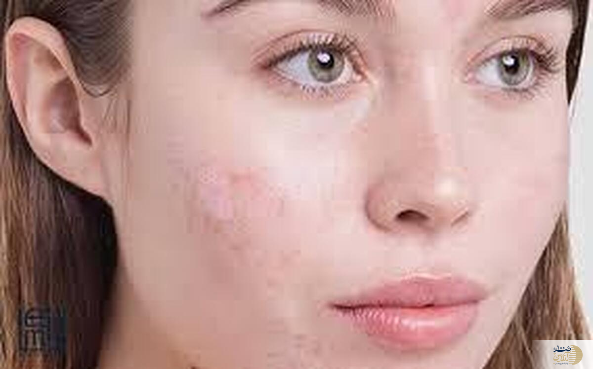مثل آب خوردن جوش های صورتتان را از بین ببرید