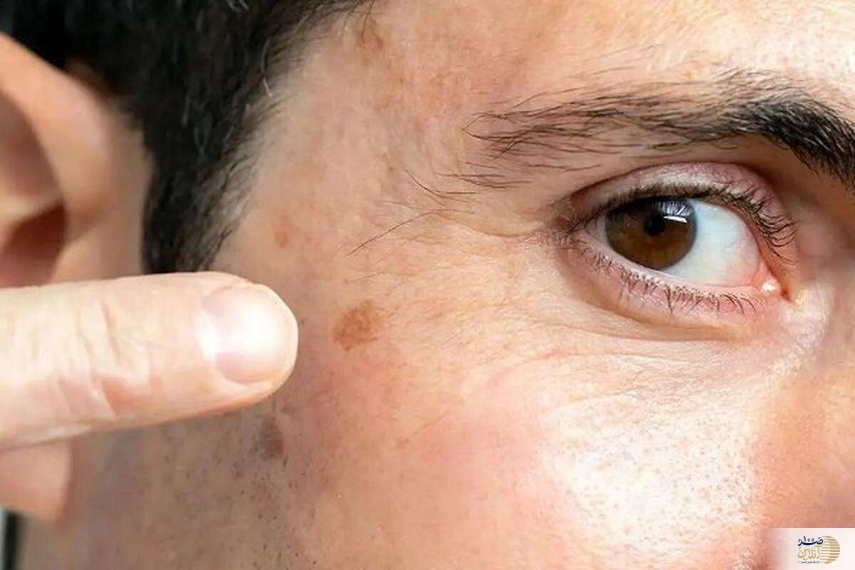 خطر مرگ/ این نشانه های پنهان روی پوست را جدی بگیرید