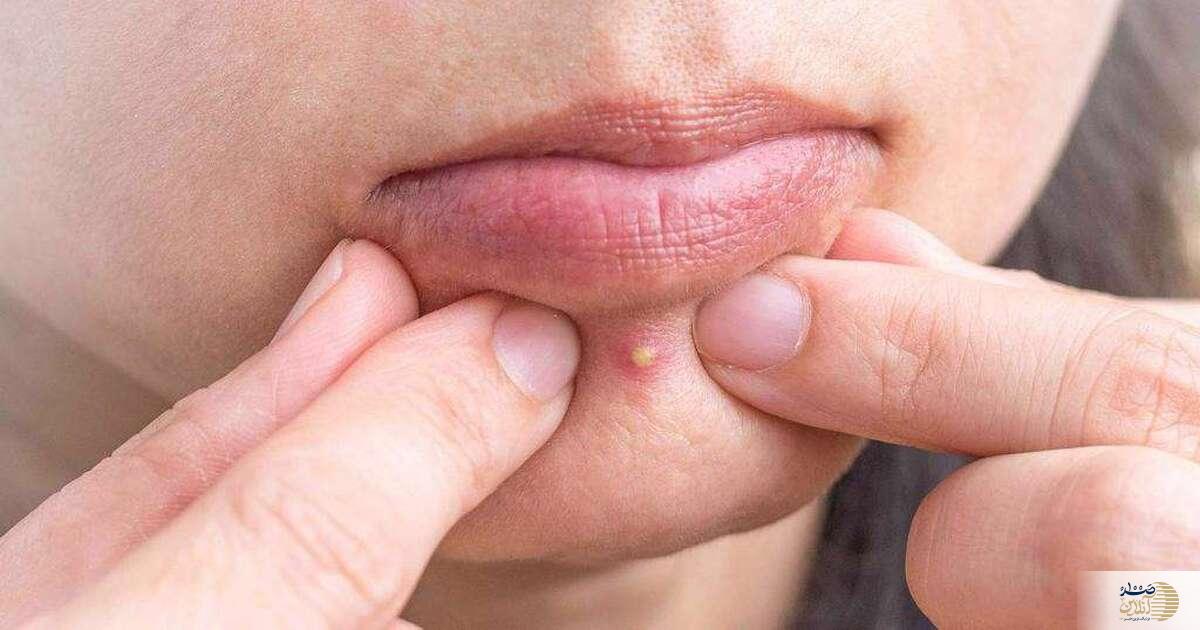 شما هم هنوز درگیر این اتفاق روی صورت تان هستید/ نگران نباشید