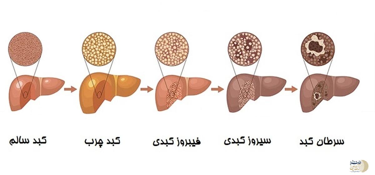 علایم بیماری های کبد را بشناسید و جدی بگیرید