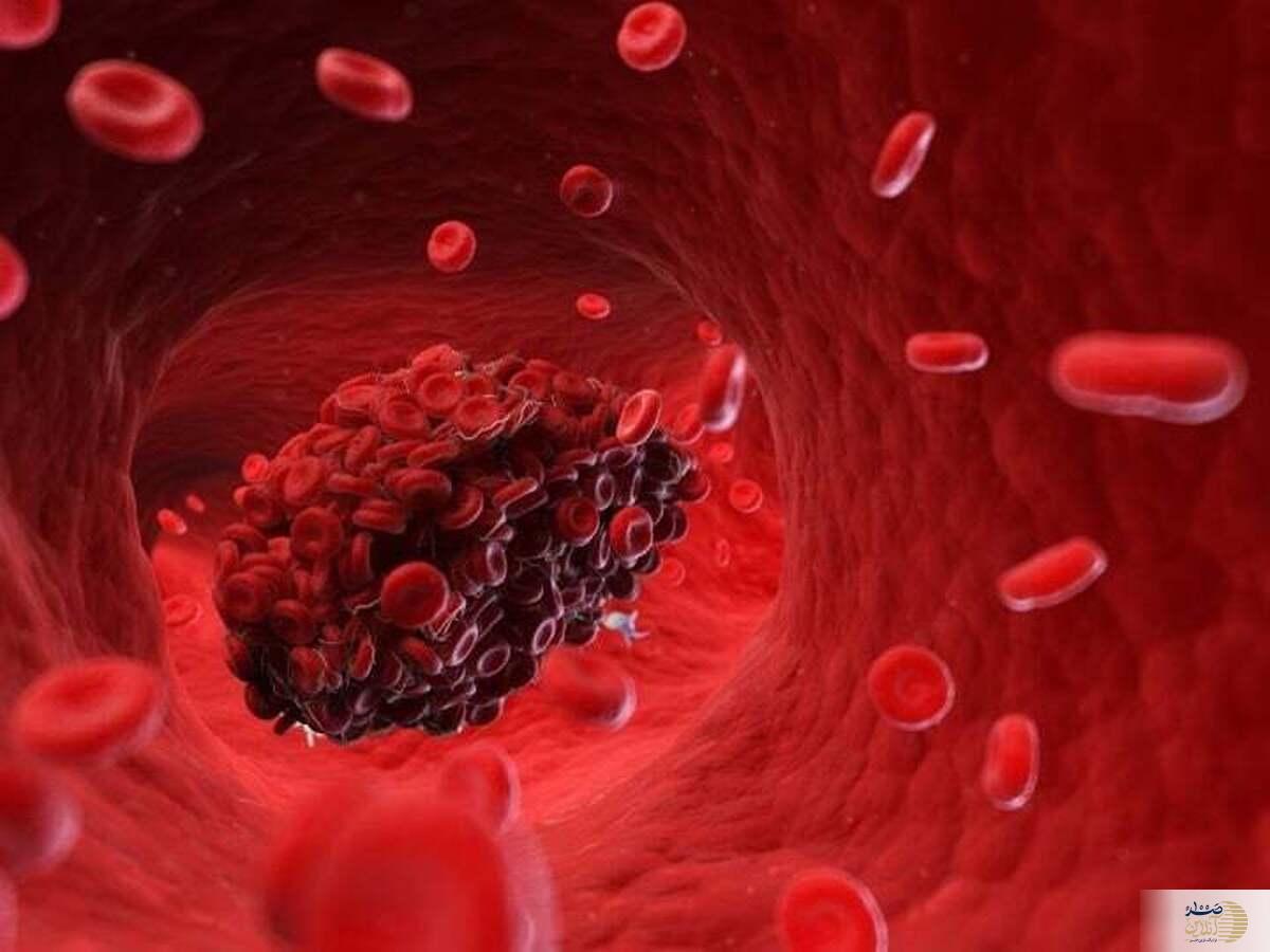 علت لخته خون در عروق چیست؟