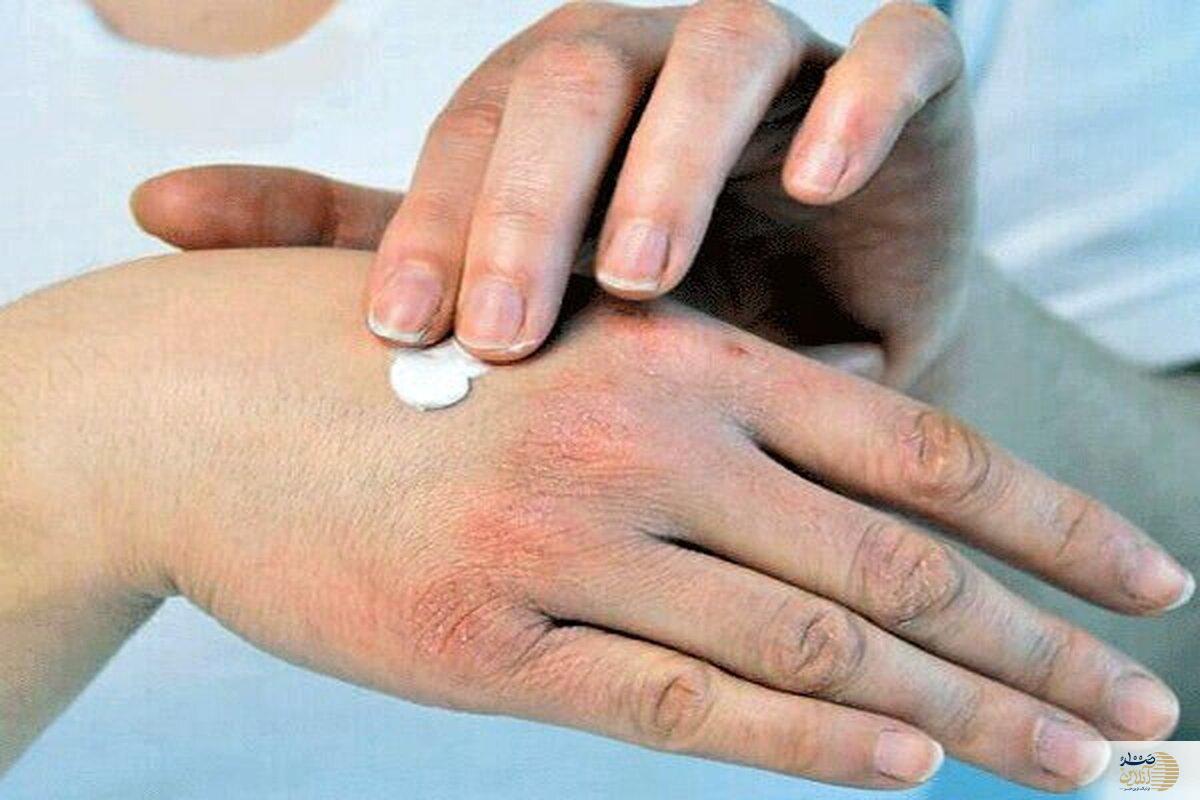 هنوز پاییز شروع نشده این مشکل پوستی را دارید!