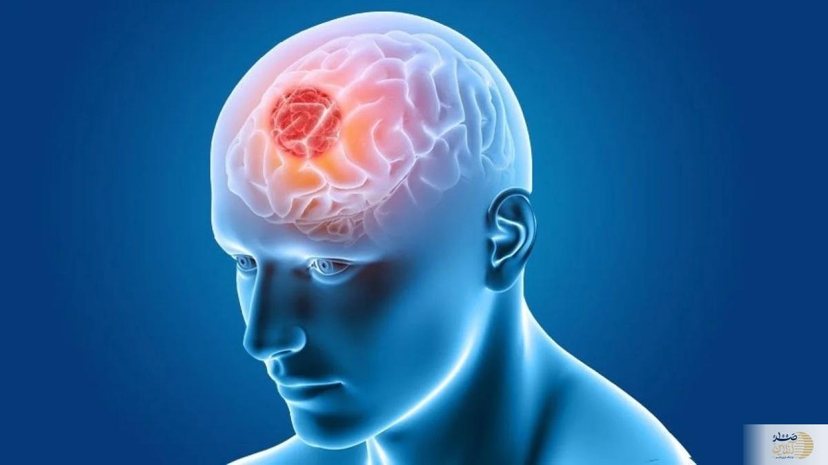 این ۷ نشانه مهم را جدی بگیرید تومور مغزی در نزدیکی شماست