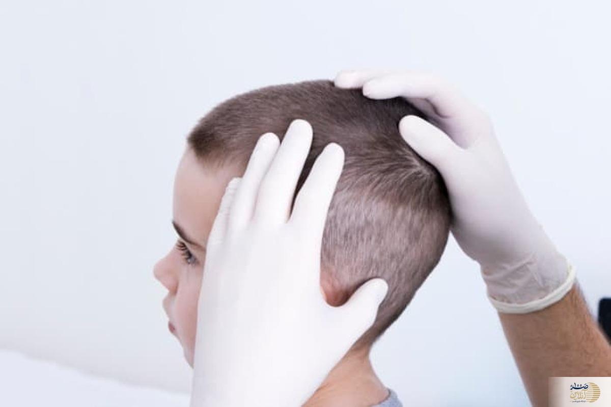 حشره ریزی که بلای موی سر می شود