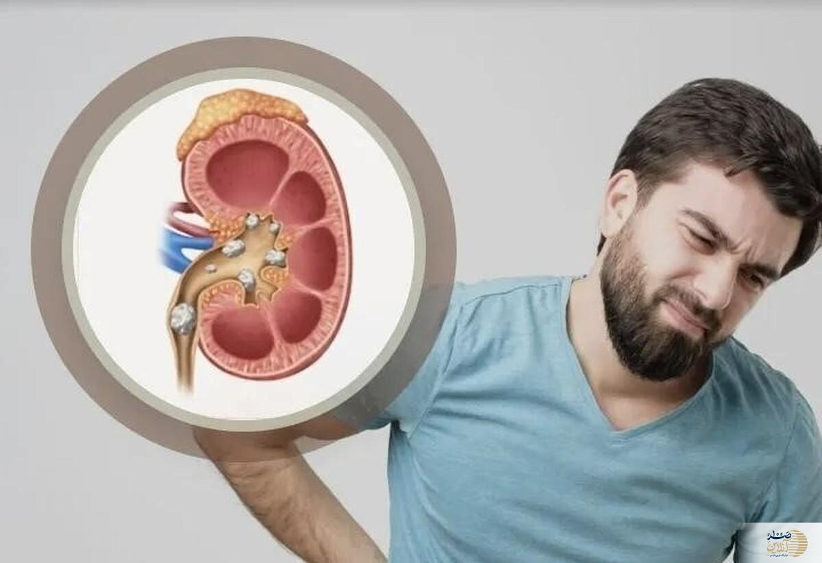 درد سنگ کلیه شما را کلافه کرده است این نوشیدنی ها مختص شماست