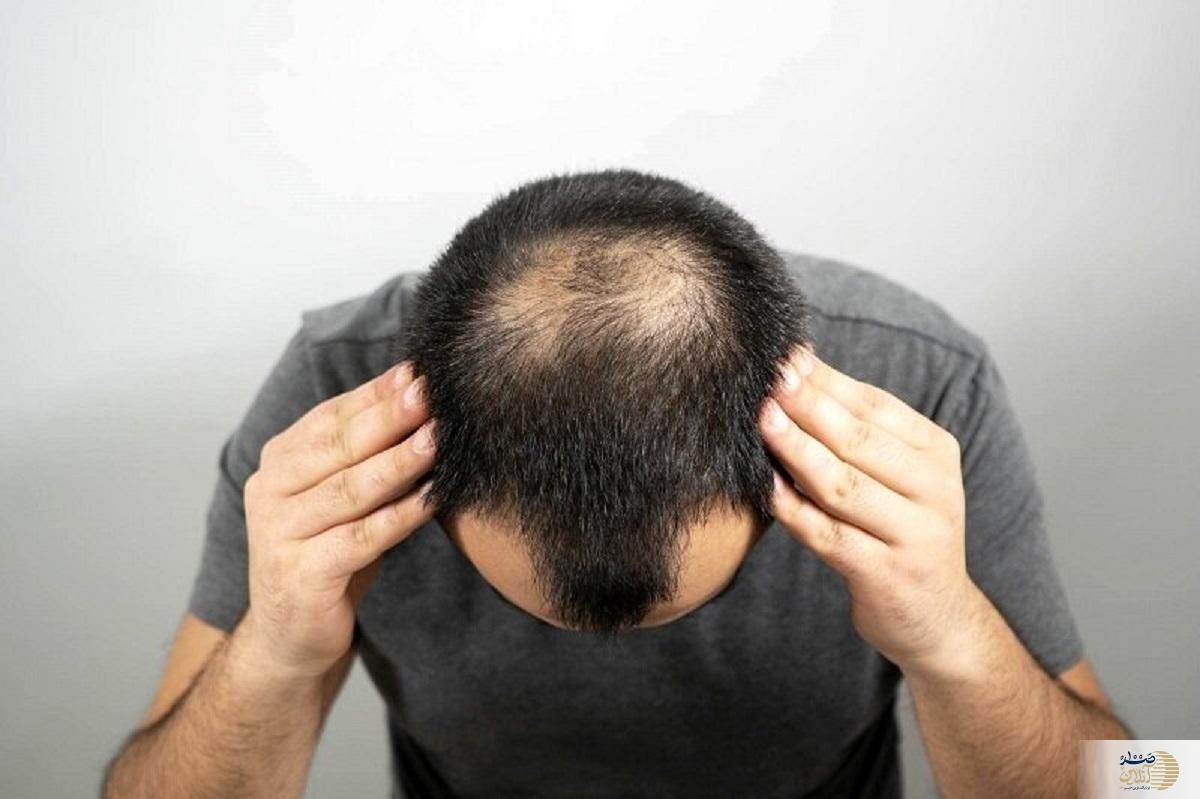 شما هم دارید کچل می شوید راه حل اینجاست