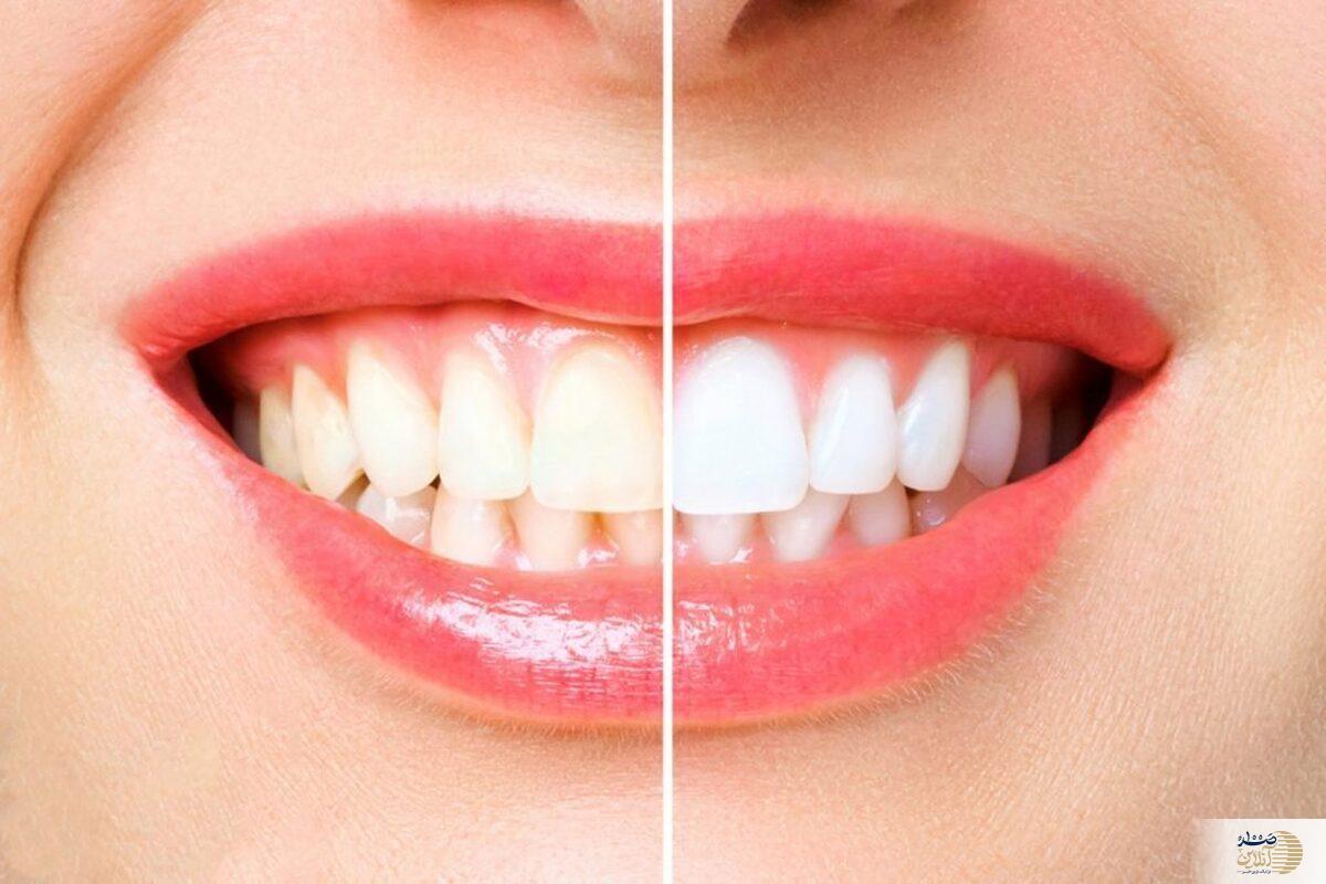 این خوراکی‌ها برای دندان های شما معجزه می کند