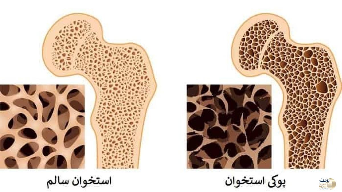 این علائم یعنی شما به پوکی استخوان مبتلا شدید
