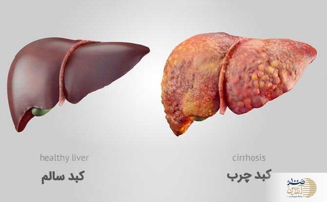 کبد چرب اگر درمان نشود شما را می کشد