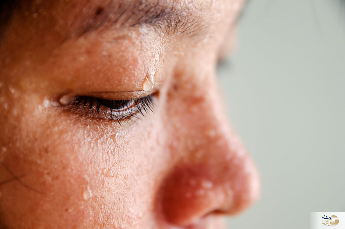 علت عرق زیاد سر و صورت چیست؟