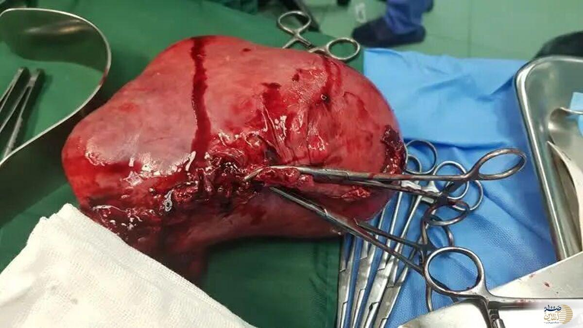 توده حدود ۲ کیلویی از شکم یک بیمار خارج شد
