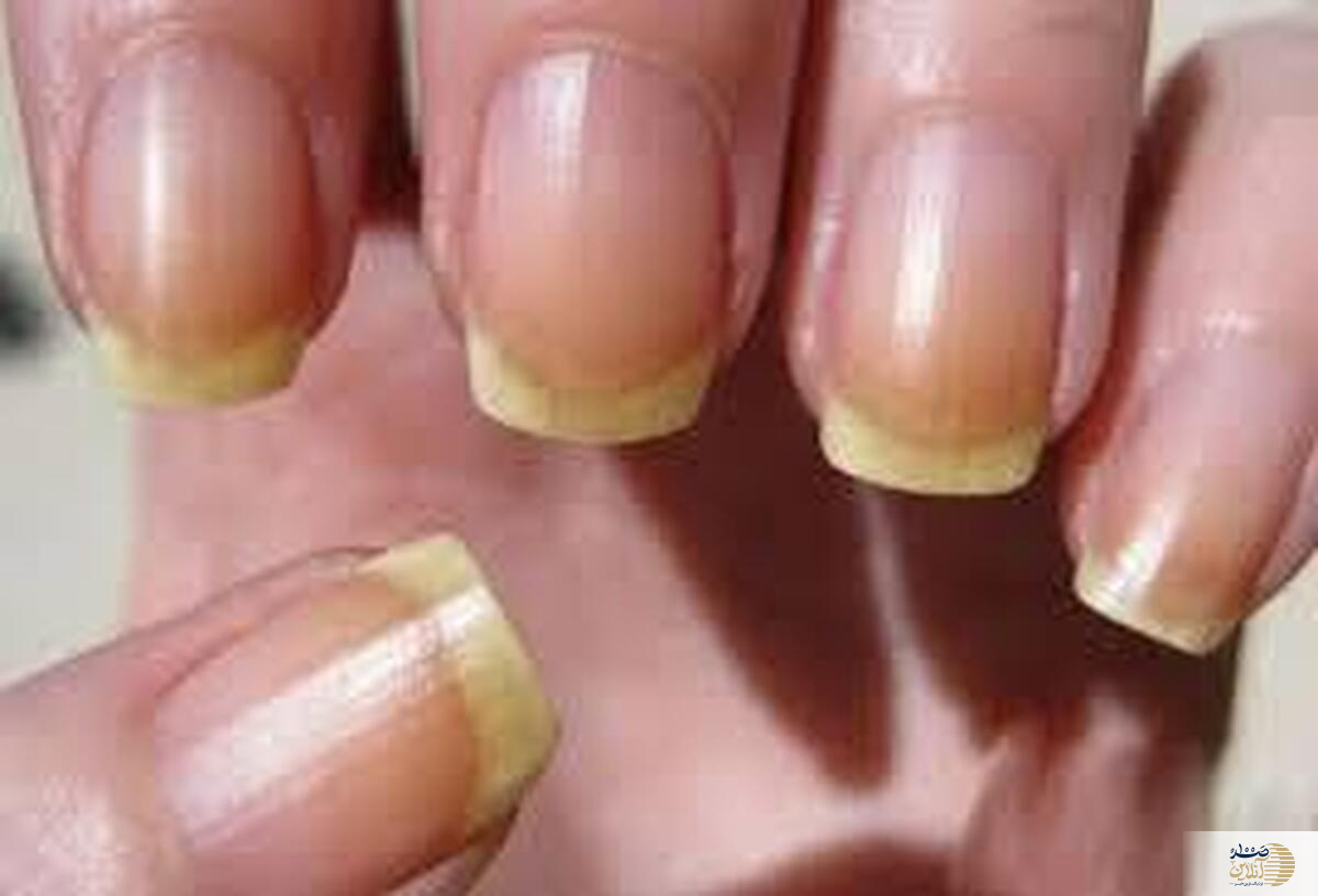 به این دلیل تغییرات ناخن را جدی بگیرید