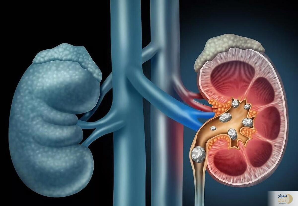 به این دلیل مهم هوای کلیه‌هایتان را داشته باشید