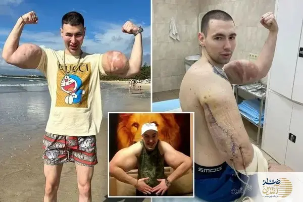 ببینید/ بدنساز زبل روسی در آستانه قطع هر دو دست