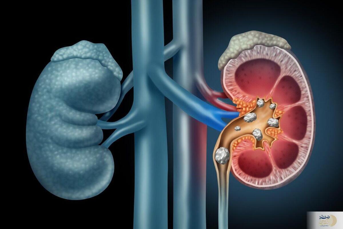 ترکیب طبیعی رونمایی شد؛ احیای عملکرد کلیه و کاهش کراتینین به زیر 2 | سلام به پایان دیالیز
