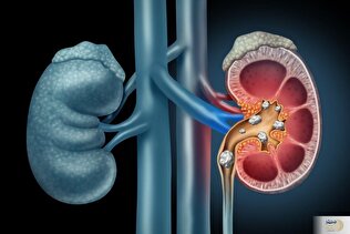 ترکیب طبیعی رونمایی شد؛ احیای عملکرد کلیه و کاهش کراتینین به زیر 2 | سلام به پایان دیالیز