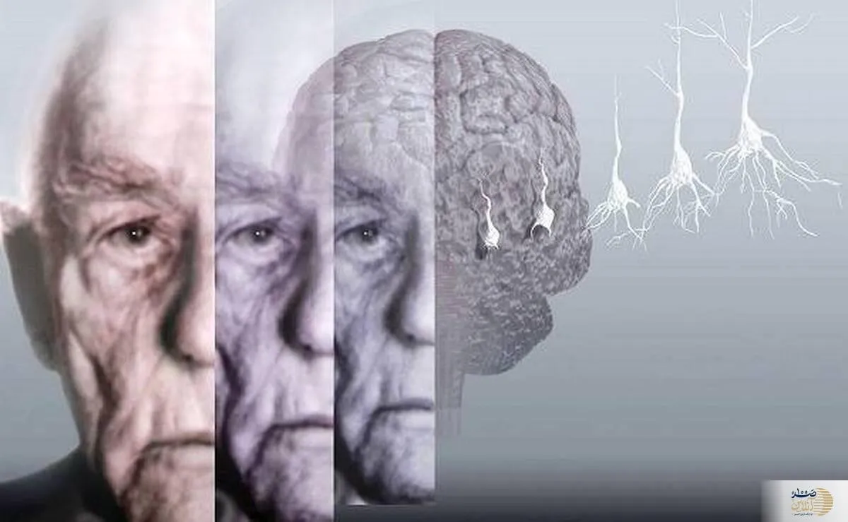 ویدیو/ تاثیر بیماری آلزایمر بر مغز