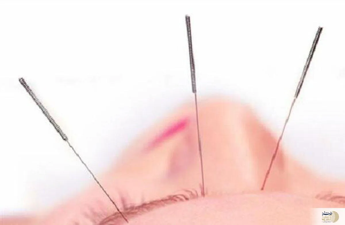 متخصصان طب سوزنی را این طور بشناسید
