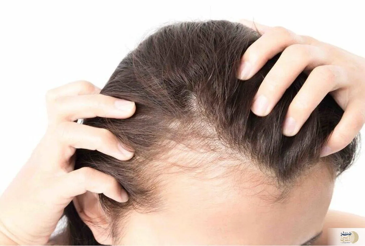 این ۳ ماده خوراکی را لب نزنید تا کچل نشوید