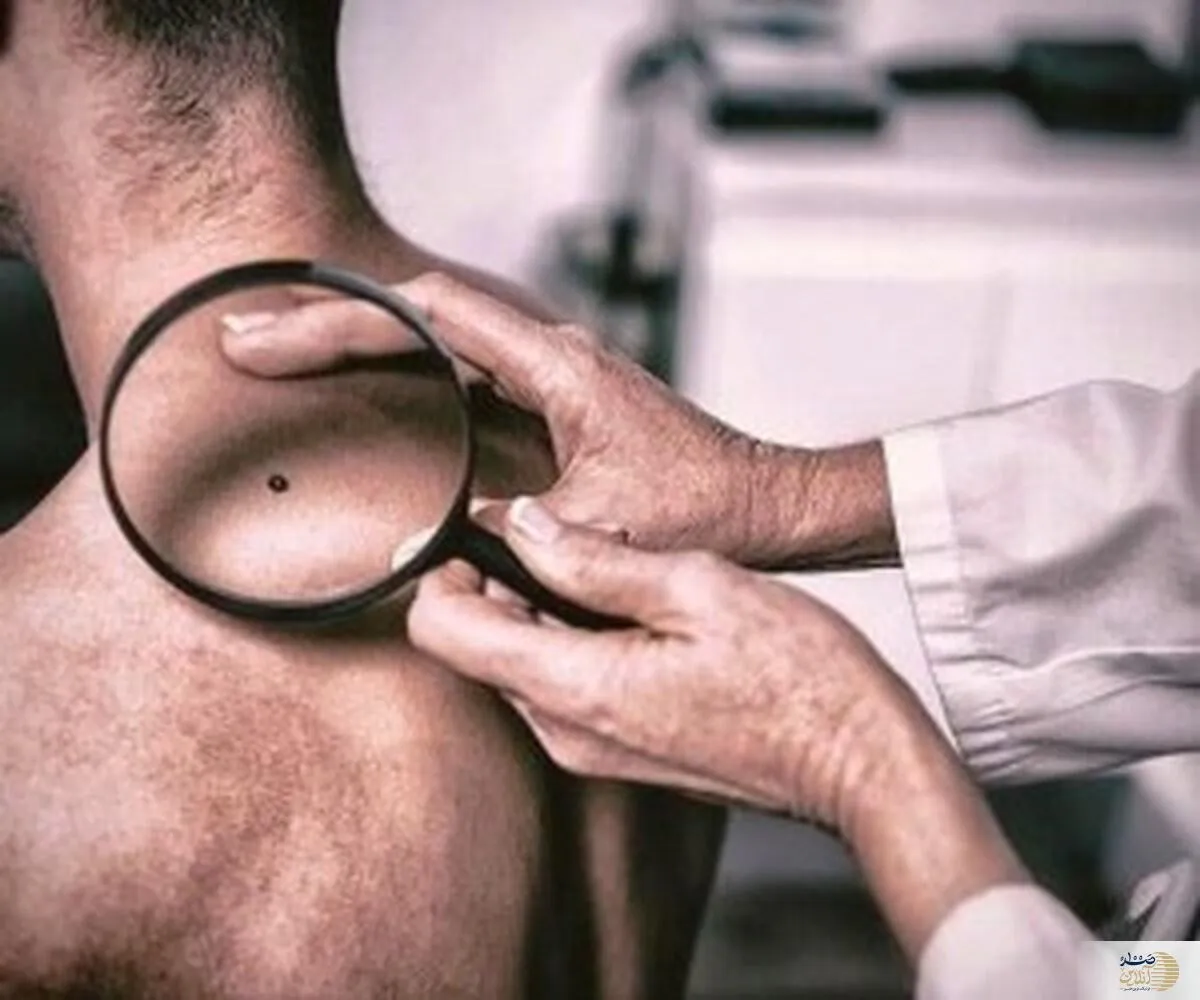 خال چه رنگی علامت سرطانه؟