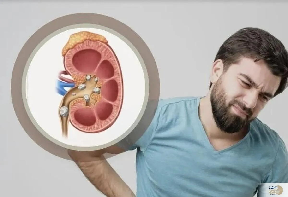 آیا می‌دانستید با نوشیدن این مقدار آب، خود را از سنگ کلیه نجات می‌دهید؟
