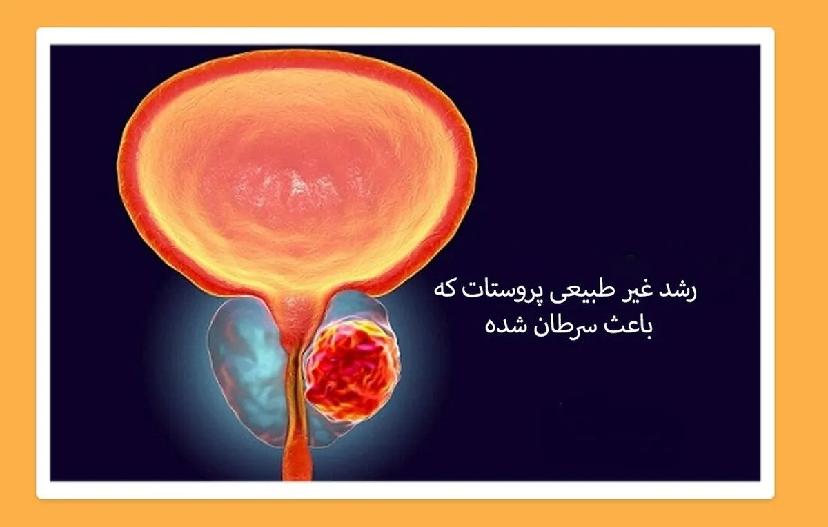 این کار خطر ابتلا به سرطان پروستات را کاهش می دهد